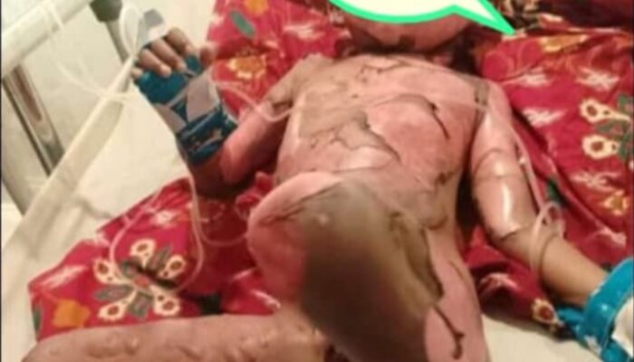 Miris!! Akibat Permainan Beleson Seorang Anak Harus Dilarikan Ke RSUD Karawang